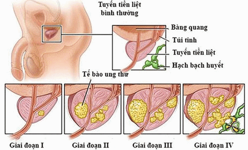 
Hình ảnh mô tả các giai đoạn của ung thư tuyến tiền liệt
