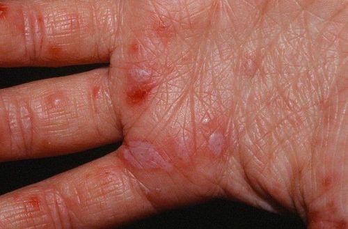 Characteristics of hand, foot and mouth disease in adults