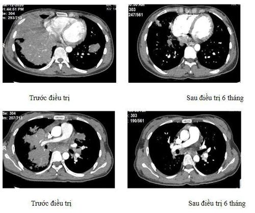 
Hình ảnh chụp CT phổi của bệnh nhân
