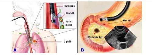 
Ống nội soi - siêu âm có gắn kim chọc hút giúp chọc hút xuyên thành thực quản một hạch trung thất(A); xuyên thành dạ dày để chọc hút 1 tổn thương dạng bọc của tuyến tụy (B).
