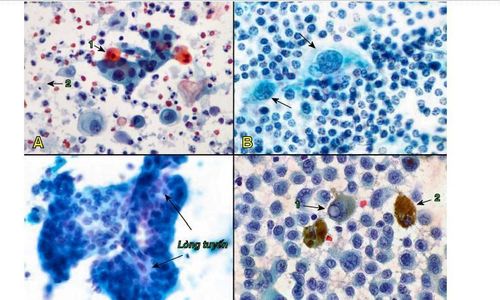 
Carcinôm tế bào gai di căn hạch, tế bào u dị dạng kết thành đám, 1 số tế bào có bào tương chứa chất sừng bắt mầu cam (1), nền tiêu bản nhiều hồng cầu và chất hoại tử (2) (A); Carcinôm tuyến vú di căn hạch, tế bào u lớn, nhân dị dạng (mũi tên), “lạ” so với các tế bào limphô bình thường của hạch (B); Carcinôm tuyến đại tràng di căn hạch, tế bào ung thư kết đám có lòng tuyến (C); Melanôm di căn hạch, tế bào u có nhân chứa thể vùi (1), một số tế bào u chứa sắc tố melanin trong bào tương (2) (D).
