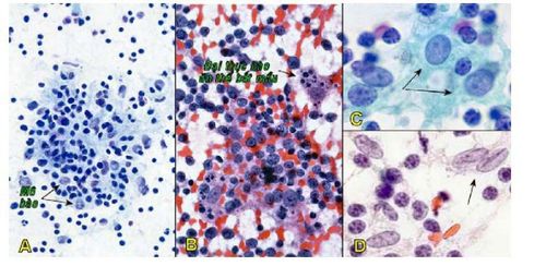 
Đám mô bào - limphô bào (A); Mảnh tâm mầm chứa các đại thực bào ăn thể bắt mầu (B); Tế bào tua nang (mũi tên,C); Tế bào tua chân xen kẽ (mũi tên,D).
