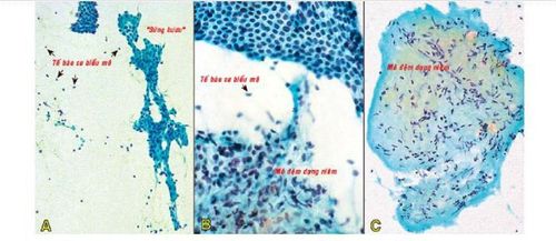 
U sợi tuyến, tế bào biểu mô kết đám giống “sừng hươu” (A) hoặc mảng lớn hình tổ ong (B); nền phết chứa nhiều tế bào cơ biểu mô và các mảnh mô đệm dạng niêm (C).
