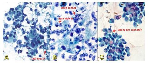 
Carcinôm tuyến vú grad cao, phết giầu tế bào, kết đám lộn xộn hoặc phân bố rời rạc, tế bào đa dạng, nhân to tăng sắc, nền tiêu bản có chất hoại tử (A); một trường hợp khác, tế bào u có nhân rất dị dạng, hạch nhân to, tỉ lệ nhân/bào tương tăng (B); trong 20% trường hợp carcinôm tuyến vú, tế bào u có bào tương chứa một không bào chất nhầy giới hạn rõ (C).
