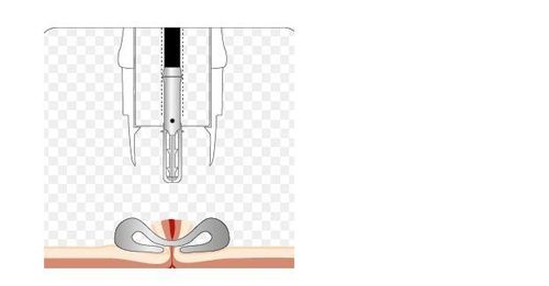 
Clip OTSC được bắn ra và đóng kín lỗ dò
