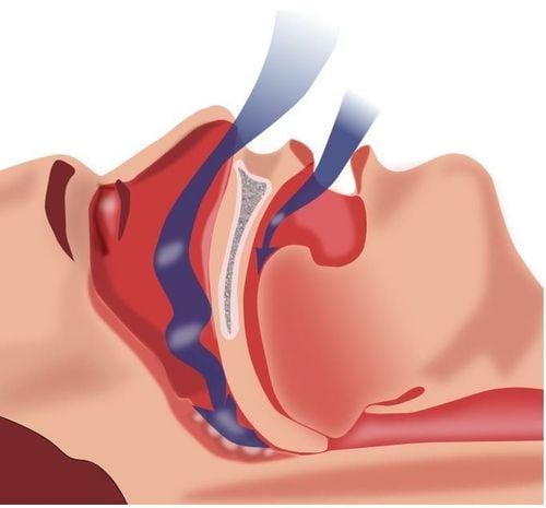 
Tình trạng thanh quản hẹp lại do các cơ vùng hầu cũng “nghỉ ngơi”
