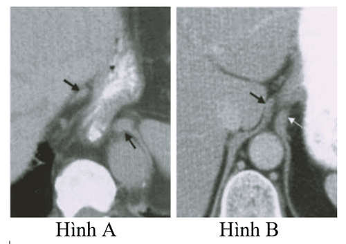 
Hình 14: Khoảng cách giữa hai trụ hoành ở BN TVKH trên CT scan
