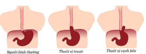 
Hình 1: Hình minh hoạ thoát vị khe hoành
