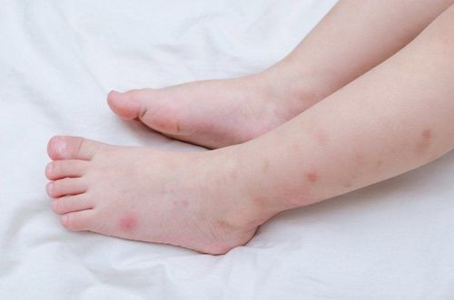 Bé 3 tuổi bị phù tay chân sau 7 ngày bị sốt xuất huyết có nguy hiểm không?