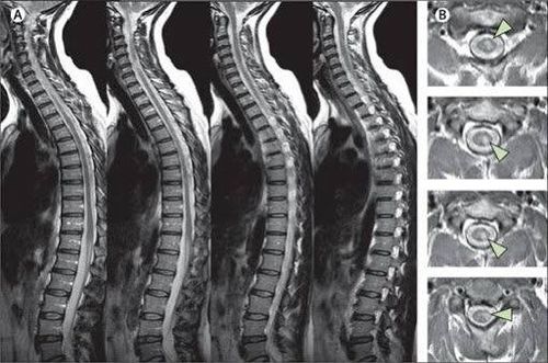 
Viêm tủy cắt ngang cần được thực hiện phương pháp chụp MRI giúp chẩn đoán viêm tủy cắt ngang vô căn
