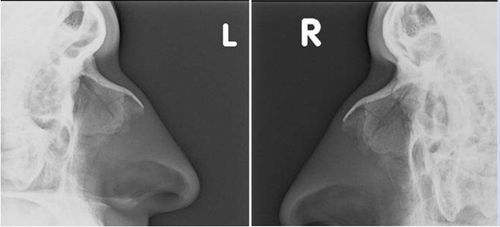 X-ray of the nose and sinuses and what you need to know