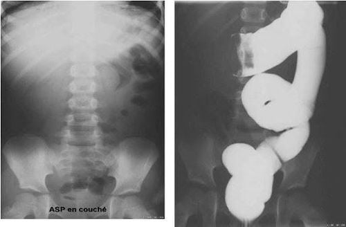 
Với đặc tính có thể đi xuyên qua chủ yếu là không khí thì những hình ảnh ghi lại được khi chụp X – quang phổi thường có màu đen
