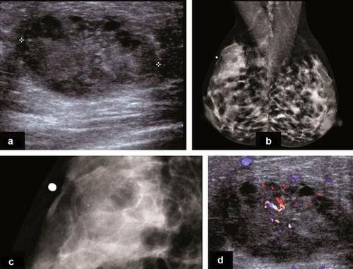 
Hình 3: Ung thư xâm lấn của vú phải ở bệnh nhân đang cho con bú. (a) Hình siêu âm cho thấy một cấu trúc giảm âm khoảng 3cm, hồi âm bên trong không đồng nhất, và giới hạn kém. (b) Nhũ ảnh tư thế chếch ở vú phải và vú trái cho thấy mô vú hai bên không đối xứng, bên phải có khối mờ tương ứng khối sờ thấy ở vú. (c) Nhũ ảnh phóng đại cho thấy một vài vôi hóa bên trong khối. (d) Siêu âm Doppler cho thấy tổn thương tăng tưới máu, chứng tỏ đây là khối đặc chứ không phải là ổ tụ dịch.
