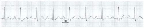 
Hình 1: Block nhĩ thất (AV) cấp 1 (khoảng PR > 200 ms).
