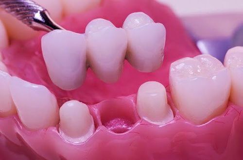 Mất răng số 2 khắc phục ra sao?