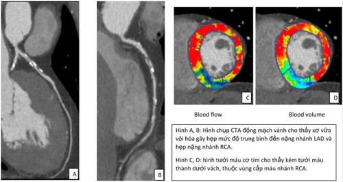 Cardiac perfusion computed tomography