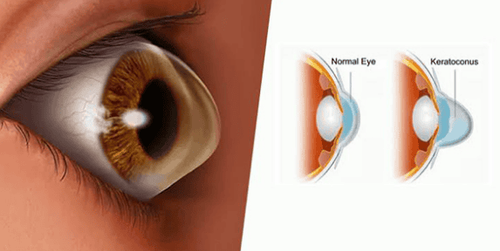 Corneal cone is dangerous?