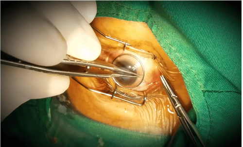 Corneal transplantation in corneal dystrophy