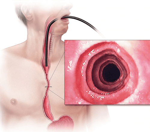 
Hình 4: Viêm thực quản do bạch cầu ái toan gây ảnh hưởng đến vận động thực quản
