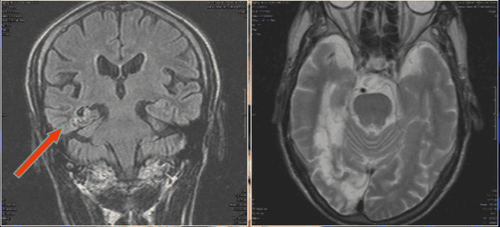 
Động kinh cục bộ trên hình ảnh MRI
