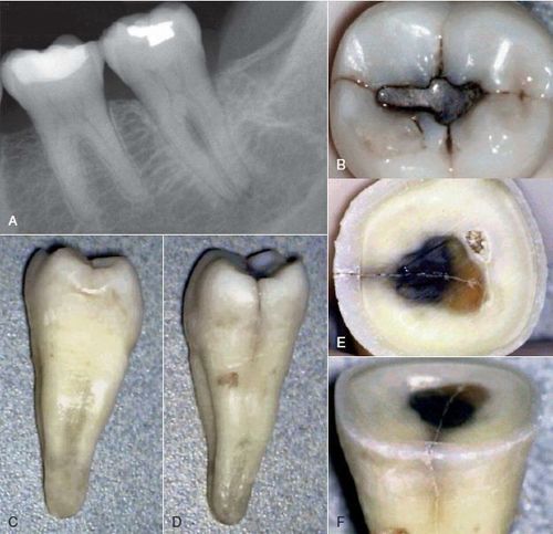 
Hình ảnh nứt chân răng
