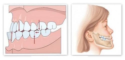 
Phẫu thuật cắt chỉnh xương hàm khi xương hàm người bệnh không cân xứng
