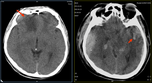 
Hình ảnh dập não và dập não kèm xuất huyết trên phim MRI
