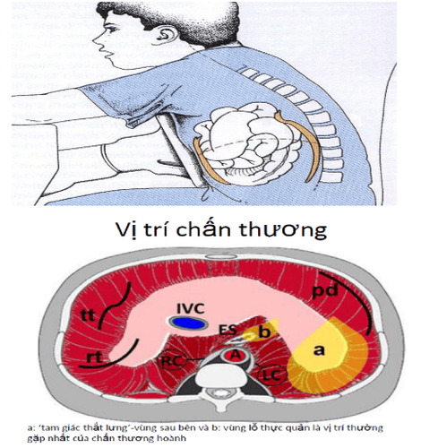 
Vỡ cơ hoành có thể gặp trong chấn thương bụng kín
