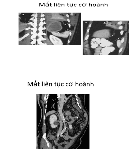 Trauma to the chest caused a rupture of the diaphragm