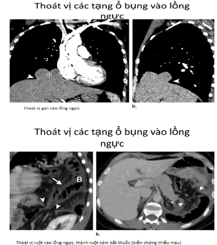 
Siêu âm trong chấn thương cơ hoành
