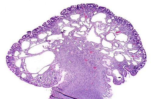 Common types of gastric epithelial polyps