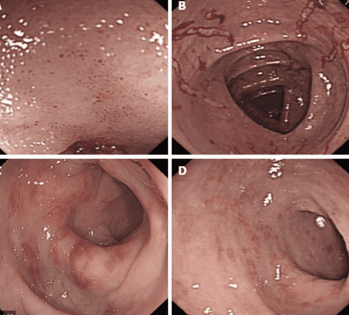 
Hình 5: Hình ảnh nội soi trình bày một trường hợp bệnh nhân bị viêm dạ dày ruột tăng bạch cầu ái toan trên nội soi đại tràng. A: Phù nề niêm mạc và nhiều điểm xuất huyết nhỏ ở đoạn xa hồi tràng; B: Phù nề niêm mạc và trợt mất niêm mạc ở đại tràng ngang; C: Phù nề từng đoạn và sung huyết ở đại tràng xuống; D: Phù nề huyết và sung huyết ở đại tràng xích ma.
