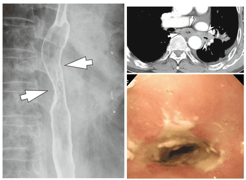 
Hình 11: Hẹp thực quản do viêm thực quản sau xạ trị (Nguồn: radiologykey.com)
