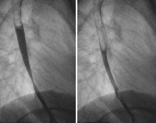 
Hình 8: Hình ảnh hẹp thực quản do viêm thực quản bạch cầu ái toan (Nguồn: learningradiology.com)
