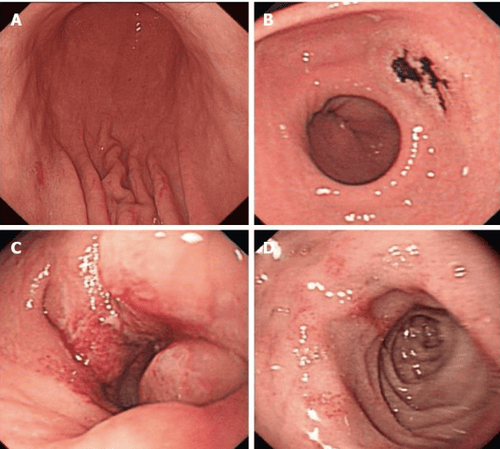 
Hình 2: Hình ảnh niêm mạc dạng nốt và viêm giả polyp ở hang vị, kết quả giải phẫu bệnh kết luận bệnh nhân có tình trạng viêm dạ dày ruột do tăng bạch cầu ái toan
