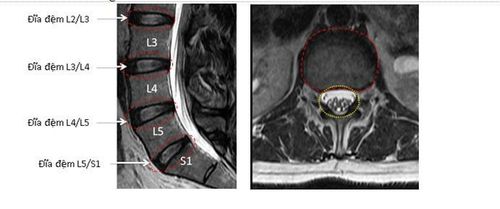 
Hình bên trái là mặt cắt dọc các đĩa đệm bình thường (trong các vòng tròn đỏ). Hình bên phải là mặt cắt ngang đĩa đệm bình thường (trong vòng tròn đỏ), ống sống chứa các rễ thần kinh tọa chùm đuôi ngựa bên trong (vòng tròn vàng).
