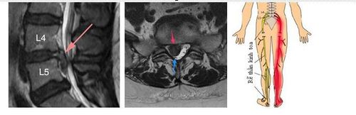 
Hình MRI cột sống thắt lưng cắt dọc (bên trái) và cắt ngang (giữa): Thoát vị đĩa đệm L4/L5 (mũi tên đỏ), chèn ép nặng rễ thần kinh tọa L5 bên phải. Mũi tên xanh chỉ rễ L5 bị chèn ép đẩy lệch ra sau. Hình bên phải là sơ đồ đường đi rễ thần kinh tọa (bệnh nhân đau thần kinh tọa phải – dây thần kinh màu đỏ).
