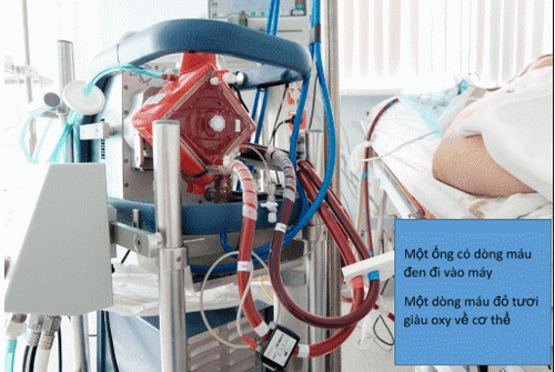 
Hình 2: Hình ảnh máy ECMO đang chạy cho người bệnh
