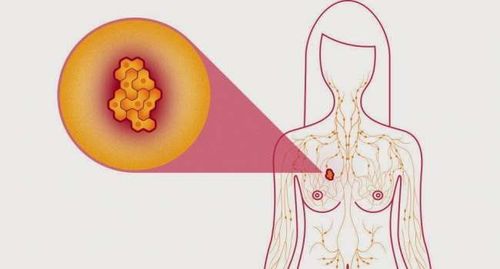 Liệu pháp bảo tồn tuyến vú trong ung thư vú