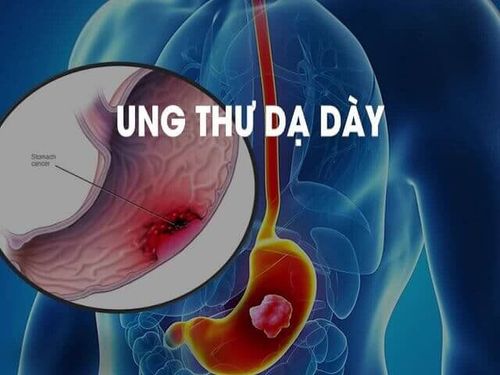 Phòng ngừa ung thư dạ dày ở những người bị nhiễm H. pylori