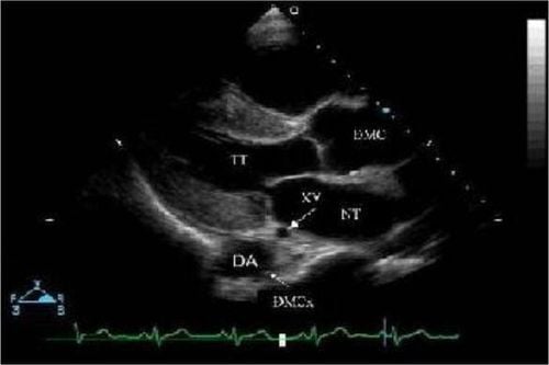 
Mặt cắt cạnh ức trái trục dọc
