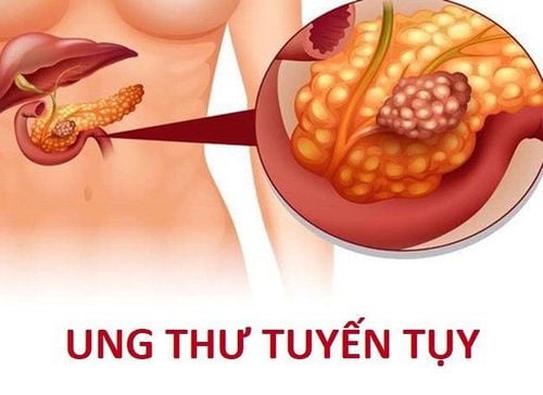 
Hạn chế thức ăn chứa nhiều đường, nước ngọt giúp phòng ngừa ung thư tuỵ
