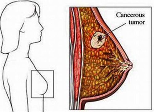 Các loại ung thư vú thường gặp