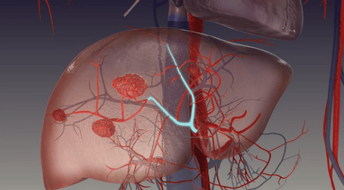 Liver hemangioma on ultrasound