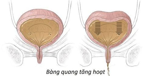 Hội chứng bàng quang tăng hoạt là một bệnh thường gặp, xảy ra khi bàng quang có sự co thắt đột ngột mà không có sự kiểm soát và khi bàng quang không chứa đầy nước tiểu