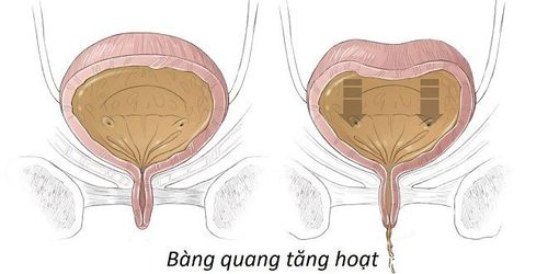 
Hội chứng bàng quang tăng hoạt khiến người bệnh không kiểm soát được tình trạng tiểu tiện
