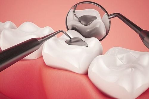 In what cases need dental fillings?