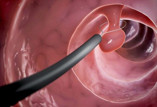 Early diagnosis of bladder neck polyps by ultrasound