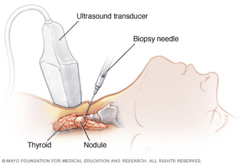 Tissue elastography in the diagnosis of thyroid cancer