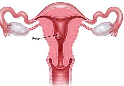 
Polyp tử cung: là một nguyên nhân khiến kinh nguyệt ra nhiều
